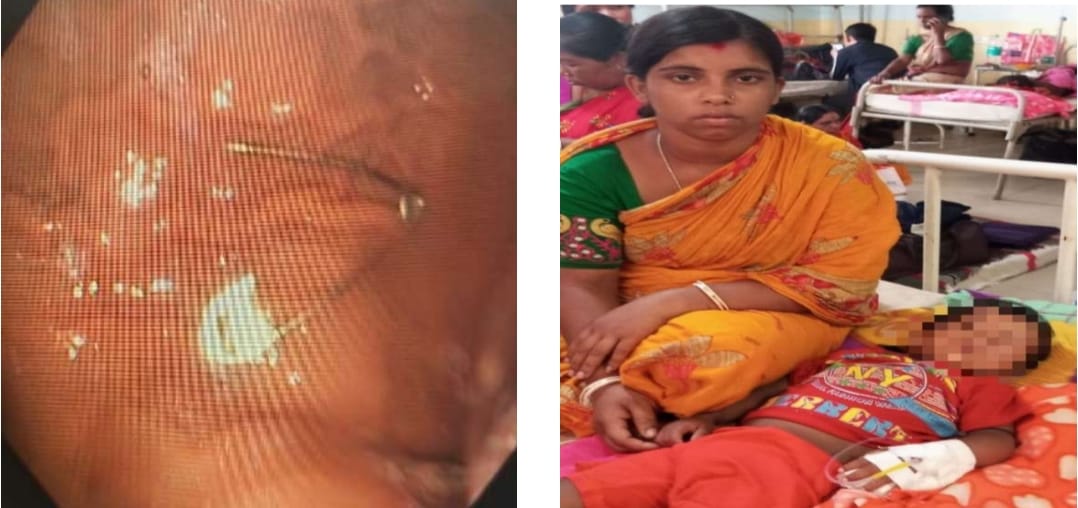 শিশু কন্যার পেট থেকে সেফটি পিন সফলভাবে অপসারণ জিবি হাসপাতালে